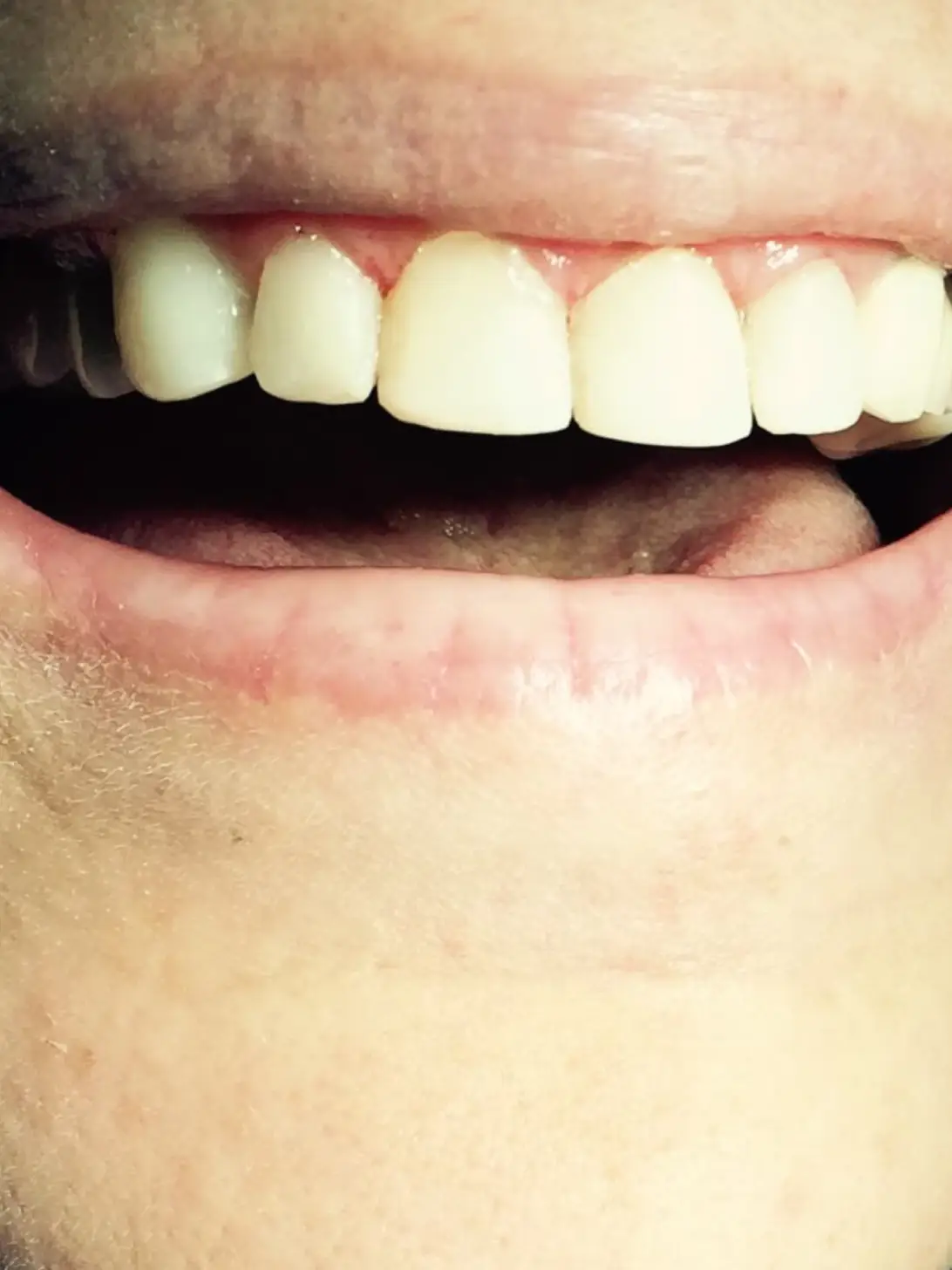 After: Composite Veneers